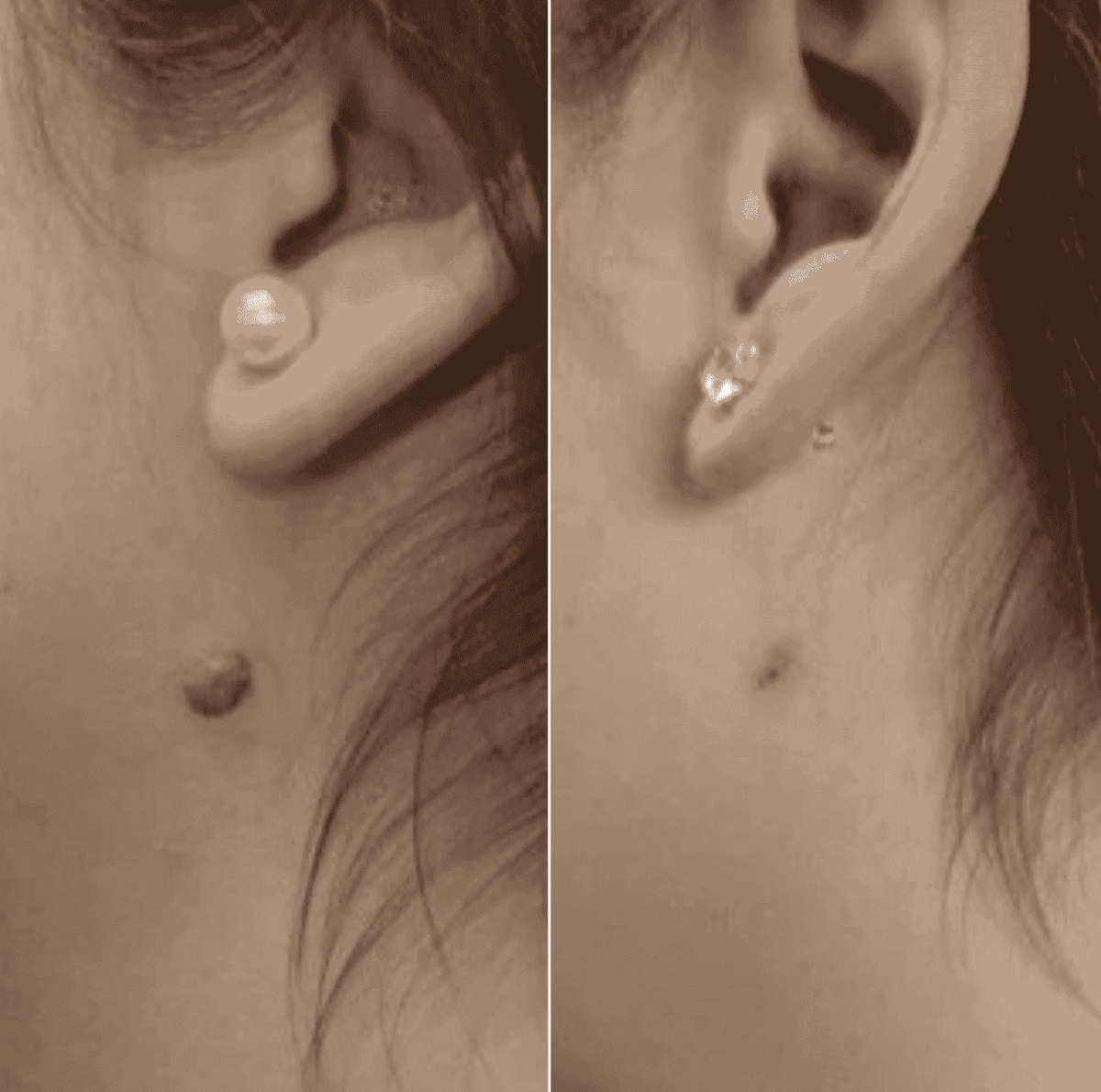 Painless Skin Tag Removal Kit