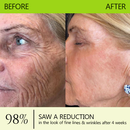 Botox & Retinol Shot - Remove Wrinkles, Sagging Jowls & Puffy Eyes