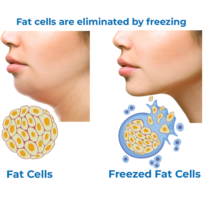 Anti-glycation CoolSculpting Mask