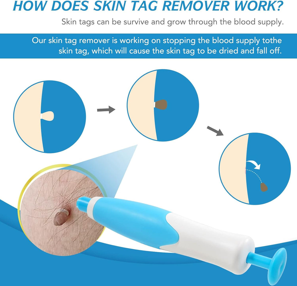 Painless Skin Tag Removal Kit