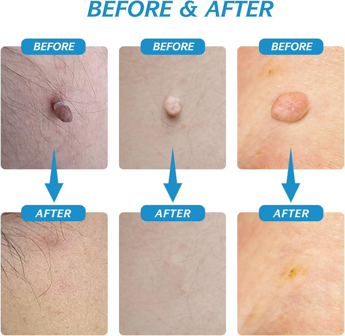 Painless Skin Tag Removal Kit