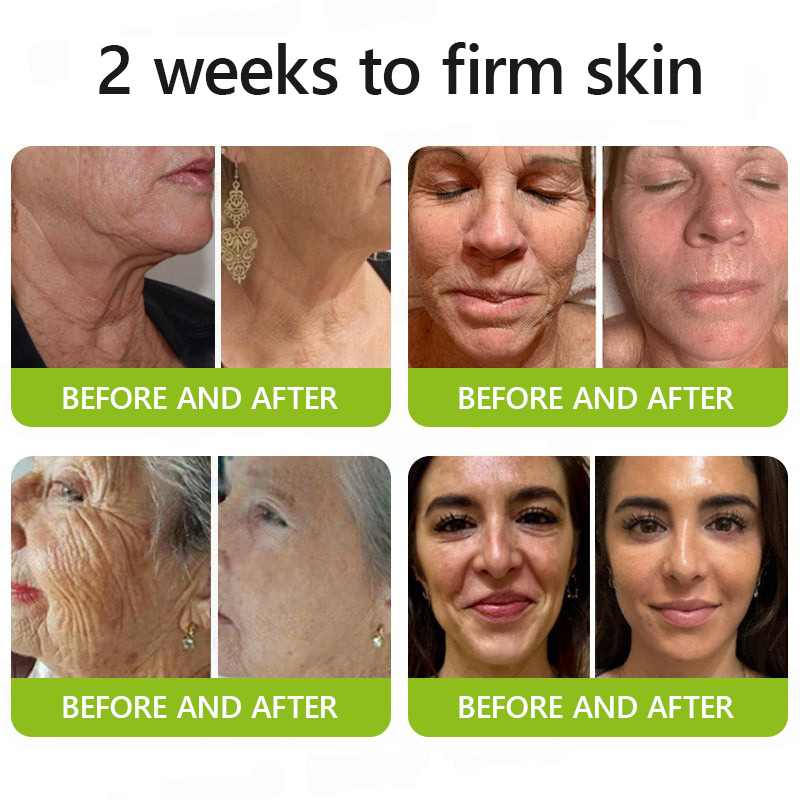 Botox & Retinol Shot - Remove Wrinkles, Sagging Jowls & Puffy Eyes