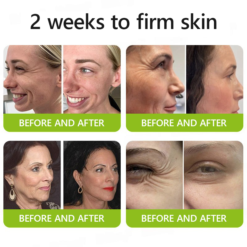Botox & Retinol Shot - Remove Wrinkles, Sagging Jowls & Puffy Eyes