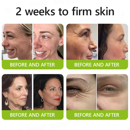 Botox & Retinol Shot - Remove Wrinkles, Sagging Jowls & Puffy Eyes