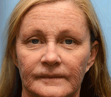Botox & Retinol Shot - Remove Wrinkles, Sagging Jowls & Puffy Eyes