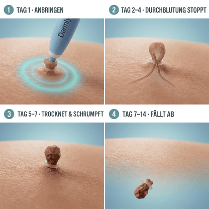 Skin Tag Removal Kit | Easy At-Home Compression Treatment