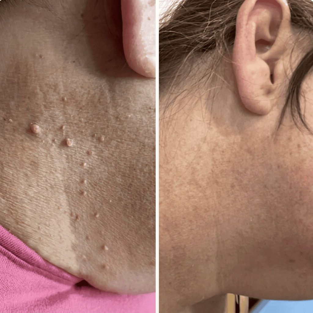 Skin Tag Removal Kit | Easy At-Home Compression Treatment