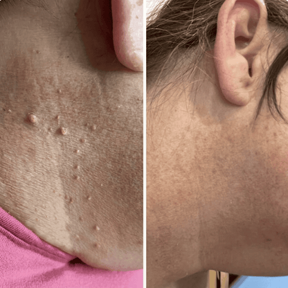 Skin Tag Removal Kit | Easy At-Home Compression Treatment