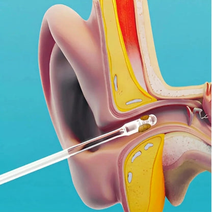 EarWax™ — One Swipe, Wax Gone