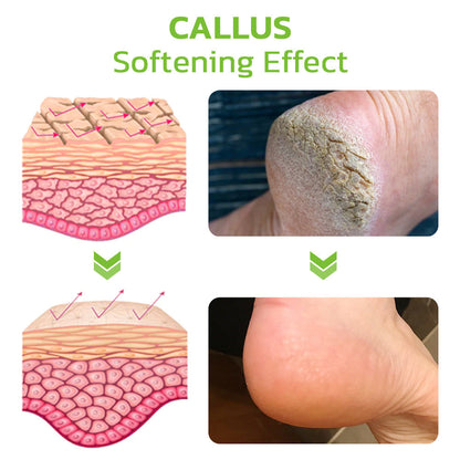 Advanced Herbal Foot Callus And Corns Removal Soak