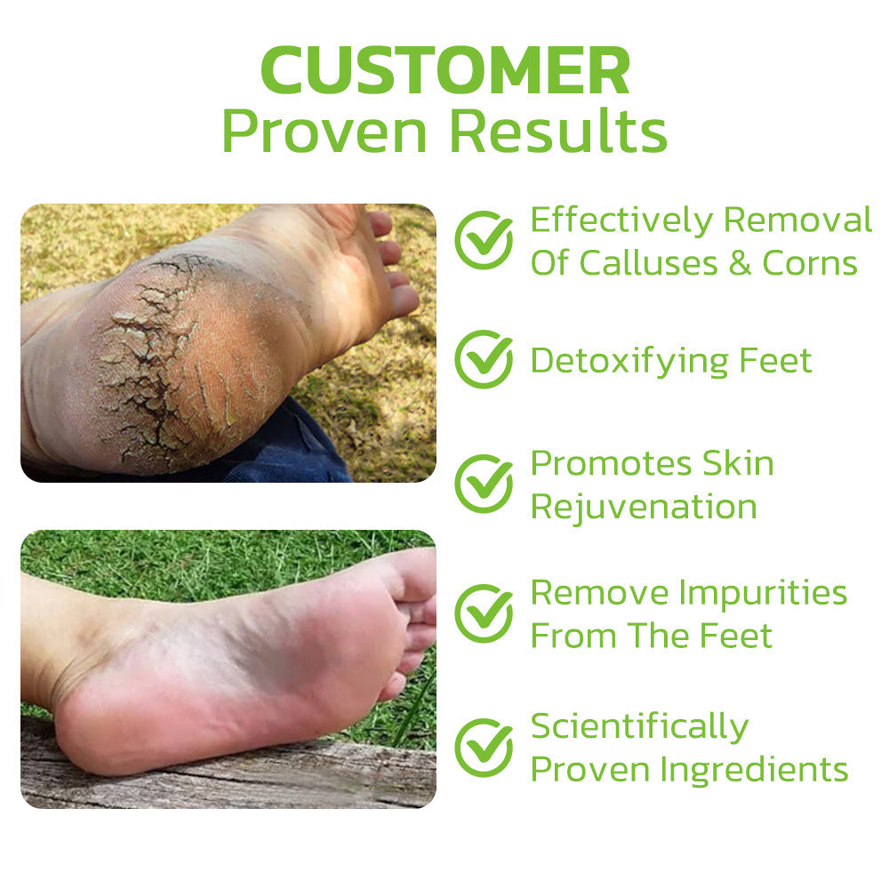 Advanced Herbal Foot Callus And Corns Removal Soak